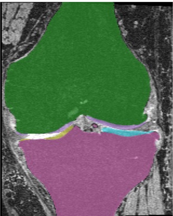 The same slice with MBEDNet's five-class segmentation painted over it.