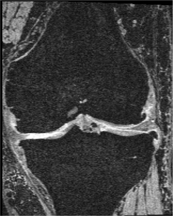 Sagittal knee MRI slice.
